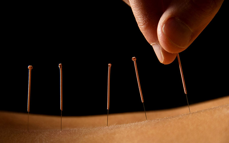 Acupuncture Needle Size