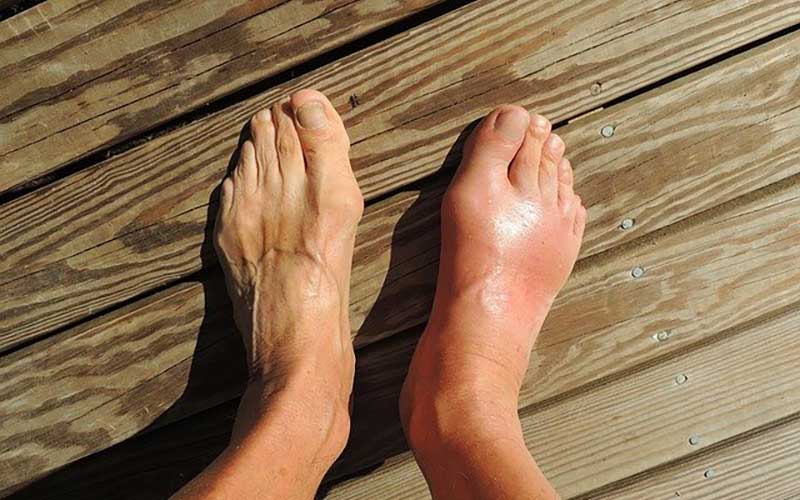 Nearly 9 million Americans suffer from gout, which is a form of inflammatory arthritis that typically affects the big toe.  It presents with sudden, severe attacks of pain, swelling, redness and tenderness, often waking you up in the middle of the night. LEARN MORE