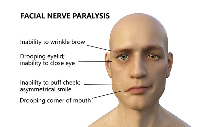 Approximately 40,000 Americans are diagnosed with Bell’s Palsy every year.  The disorder presents with a sudden onset of facial paralysis, which may be preceded by slight fever, stiff neck, or weakness on one side of the face.LEARN MORE